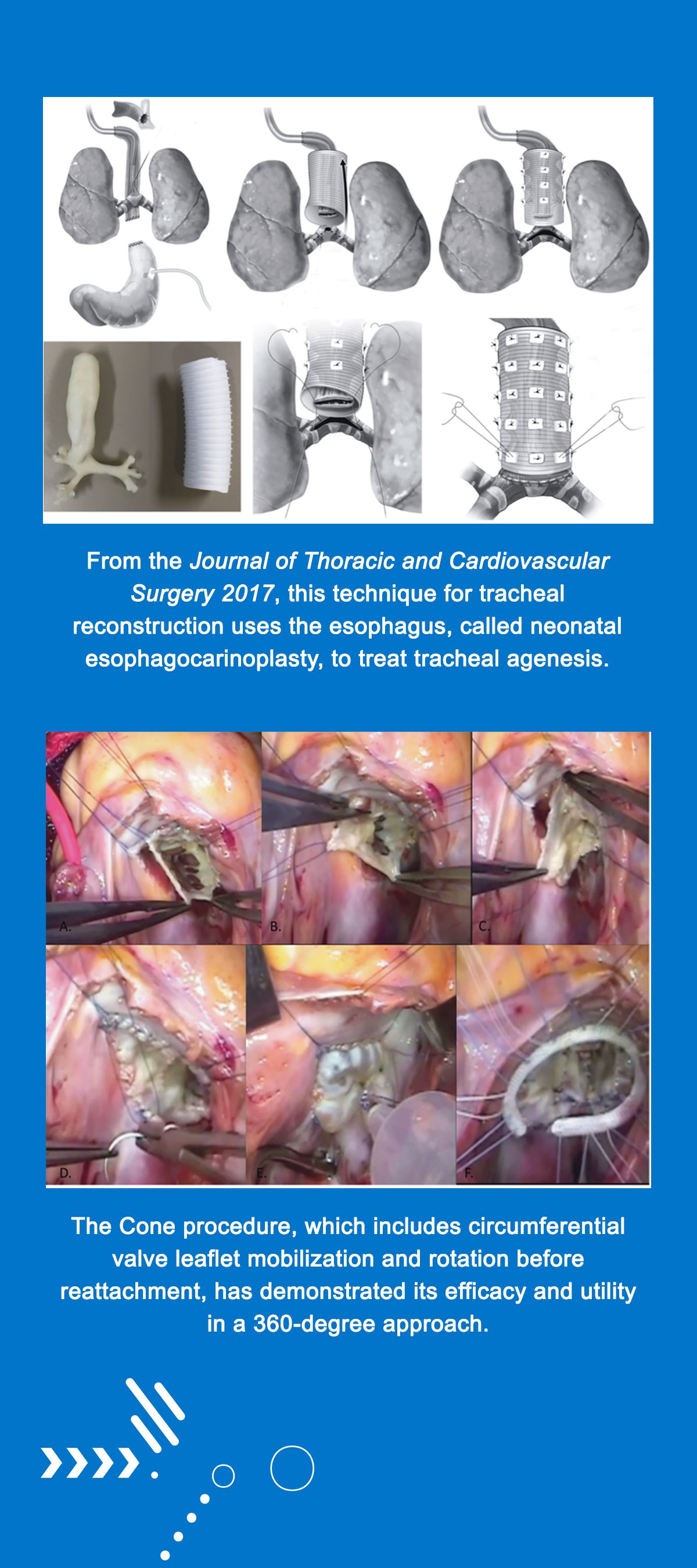 Diagram of technique for tracheal reconstruction